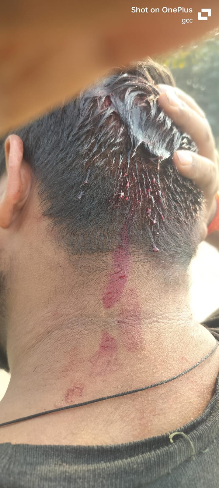 पुरानी रंजिश में अमन तिवारी पर लाठी-डंडों से हमला, हालत गंभीर